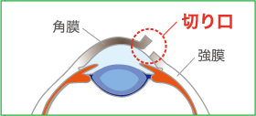 角膜（黒目）と強膜（白目）の間に3mm弱の切り口を作成